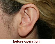 plastic-surgery-prominent-ear 